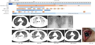 Successful treatment of acute respiratory distress syndrome caused by hypervirulent Klebsiella pneumoniae with extracorporeal membrane oxygenation and continuous renal replacement therapy: A case report and literature review
